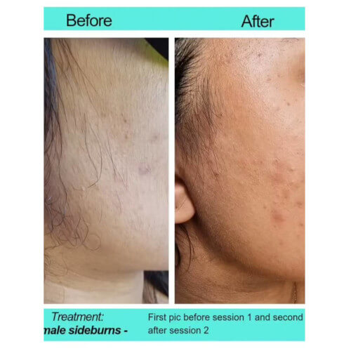 Before and After Picture of Women Face Side
